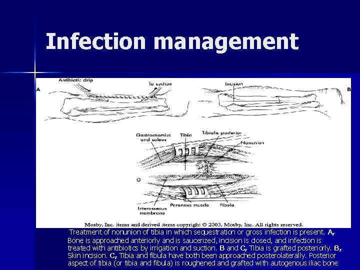 Infection management Treatment of nonunion of tibia in which sequestration or gross infection is