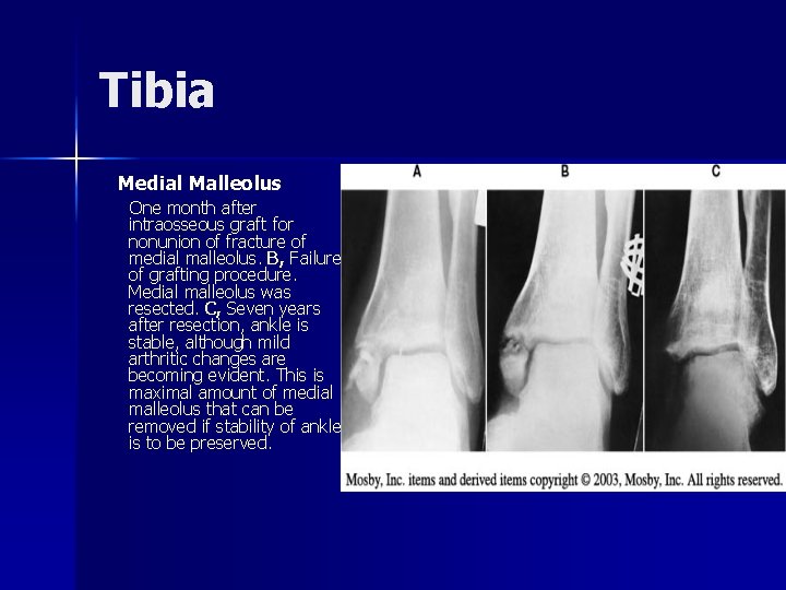 Tibia Medial Malleolus One month after intraosseous graft for nonunion of fracture of medial