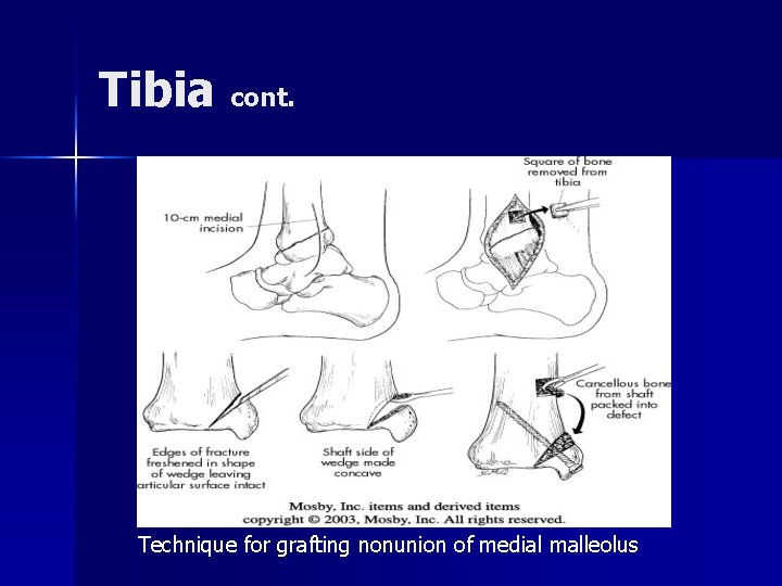 Tibia cont. Technique for grafting nonunion of medial malleolus 