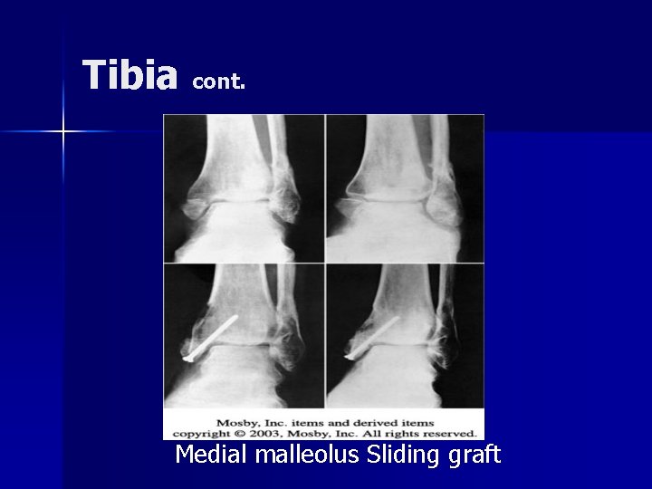 Tibia cont. Medial malleolus Sliding graft 