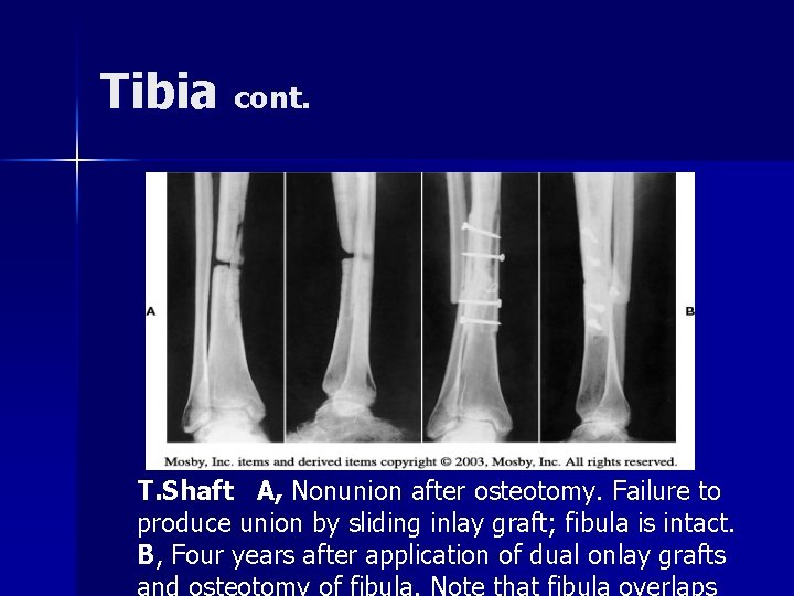 Tibia cont. T. Shaft A, Nonunion after osteotomy. Failure to produce union by sliding