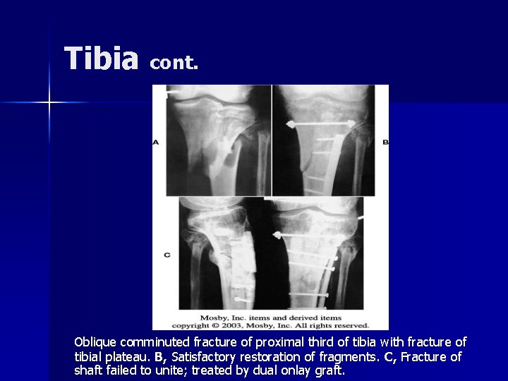 Tibia cont. Oblique comminuted fracture of proximal third of tibia with fracture of tibial