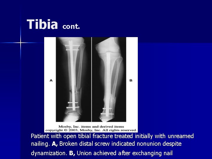 Tibia cont. Patient with open tibial fracture treated initially with unreamed nailing. A, Broken