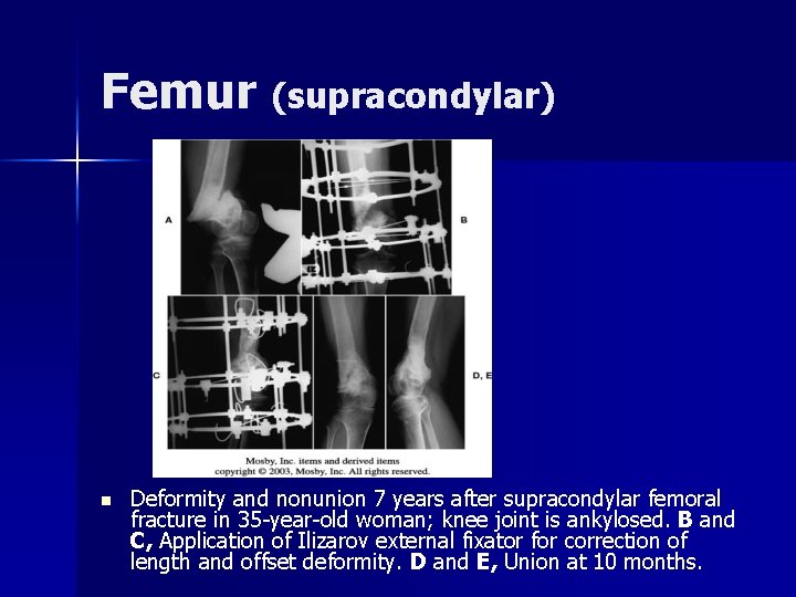 Femur (supracondylar) n Deformity and nonunion 7 years after supracondylar femoral fracture in 35