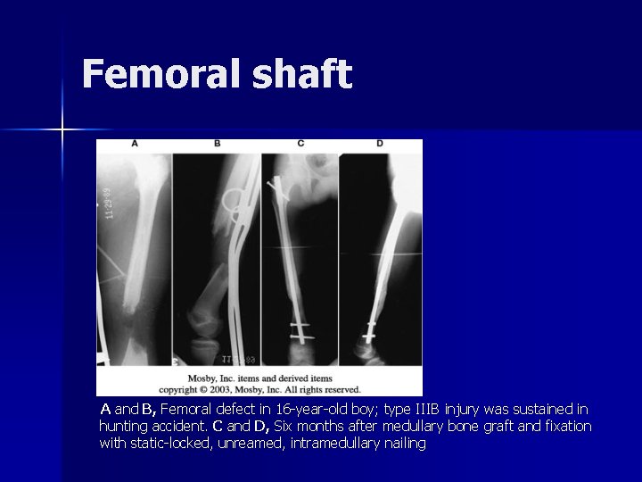 Femoral shaft A and B, Femoral defect in 16 -year-old boy; type IIIB injury