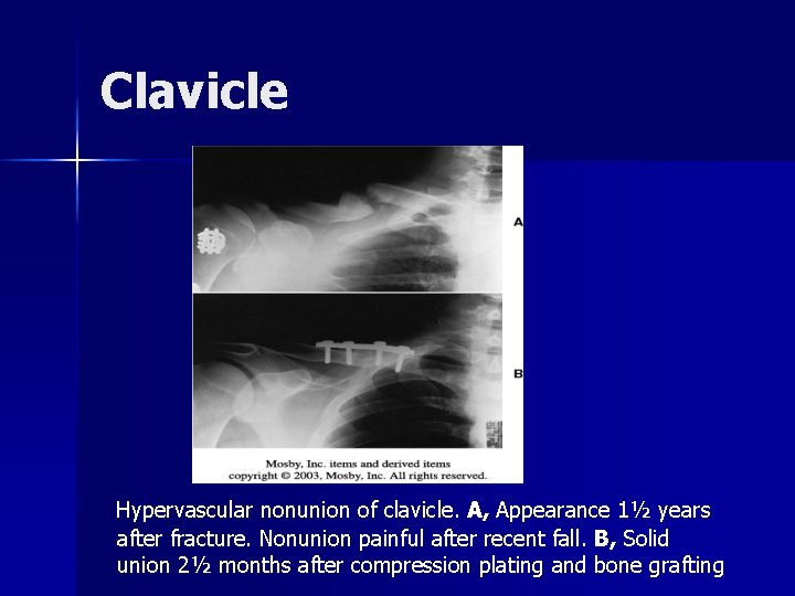 Clavicle Hypervascular nonunion of clavicle. A, Appearance 1½ years after fracture. Nonunion painful after