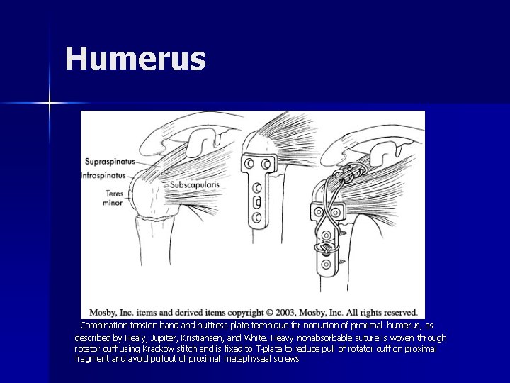 Humerus Combination tension band buttress plate technique for nonunion of proximal humerus, as described