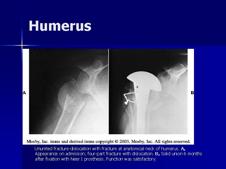 Humerus Ununited fracture-dislocation with fracture at anatomical neck of humerus. A, Appearance on admission;