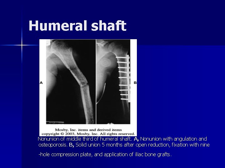 Humeral shaft Nonunion of middle third of humeral shaft. A, Nonunion with angulation and