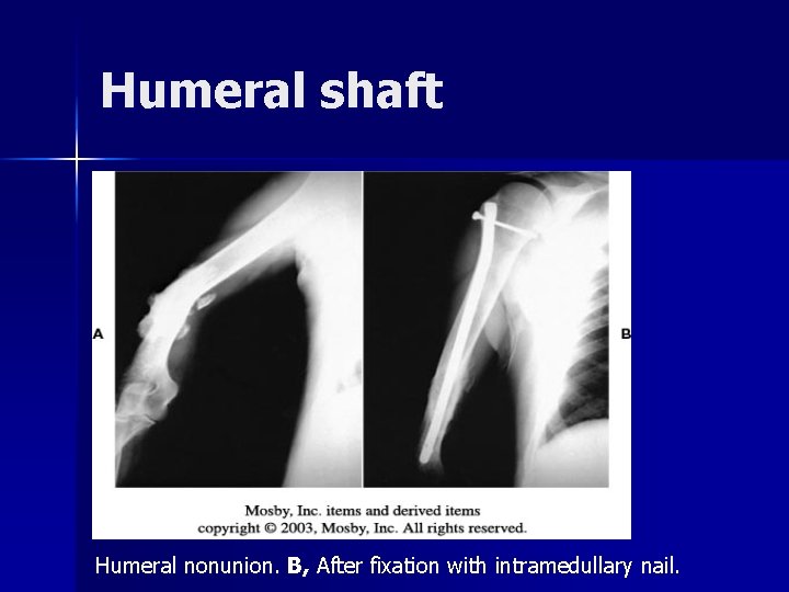 Humeral shaft Humeral nonunion. B, After fixation with intramedullary nail. 