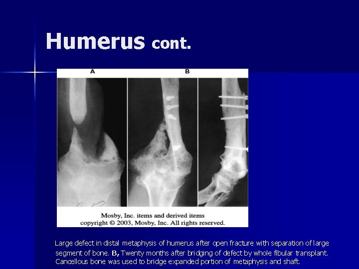Humerus cont. Large defect in distal metaphysis of humerus after open fracture with separation