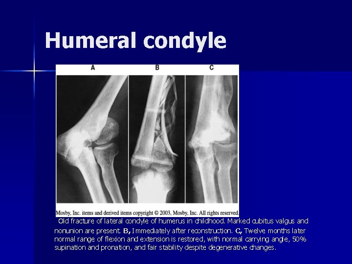 Humeral condyle Old fracture of lateral condyle of humerus in childhood. Marked cubitus valgus