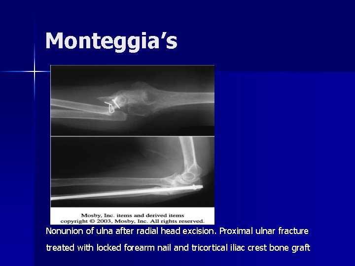Monteggia’s Nonunion of ulna after radial head excision. Proximal ulnar fracture treated with locked