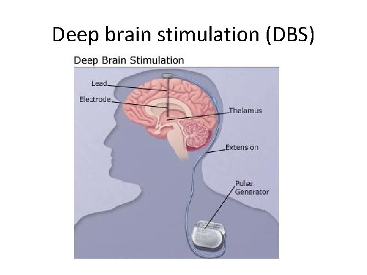 Deep brain stimulation (DBS) Deep brain stimulation (DBS)