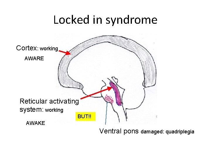 Locked in syndrome Cortex: working AWARE Reticular activating system: working BUT!! AWAKE Ventral pons