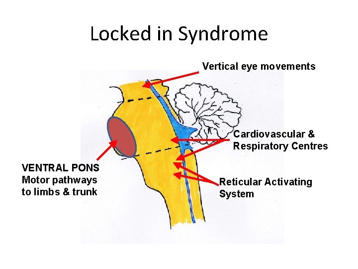 Locked in Syndrome Vertical eye movements Cardiovascular & Respiratory Centres VENTRAL PONS Motor pathways