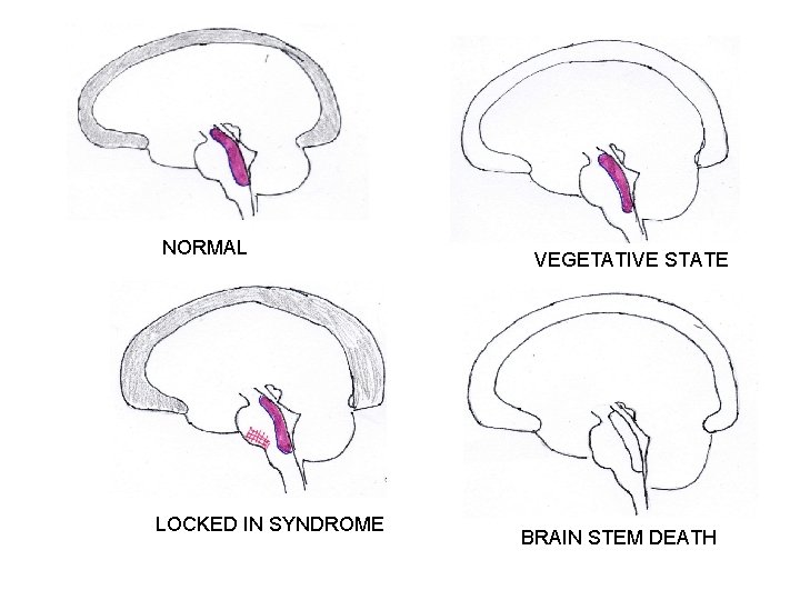 NORMAL LOCKED IN SYNDROME VEGETATIVE STATE BRAIN STEM DEATH 