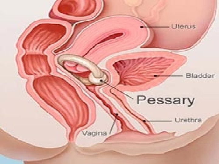 1. Maintenance Pessaries can be removed daily, weekly, or monthly, at patients’ discretion, for