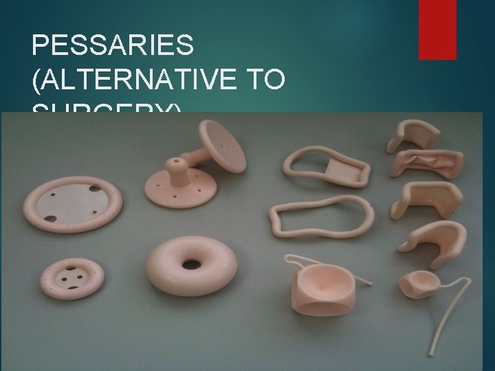 PESSARIES (ALTERNATIVE TO SURGERY) 