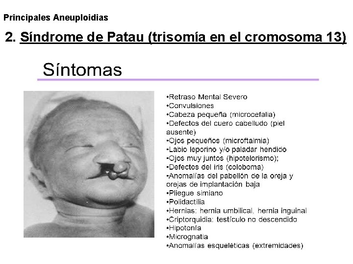 Principales Aneuploidias 2. Síndrome de Patau (trisomía en el cromosoma 13) 