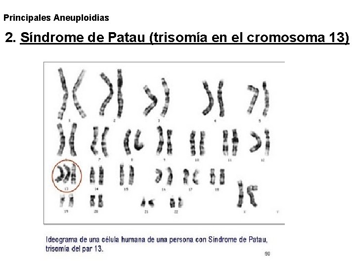Principales Aneuploidias 2. Síndrome de Patau (trisomía en el cromosoma 13) Principales Aneuploidias 2. Síndrome de Patau (trisomía en el cromosoma 13)