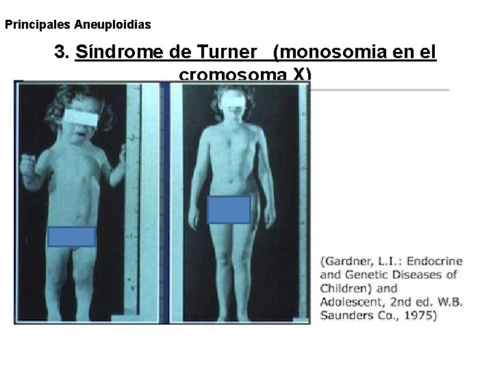 Principales Aneuploidias 3. Síndrome de Turner (monosomia en el cromosoma X) 