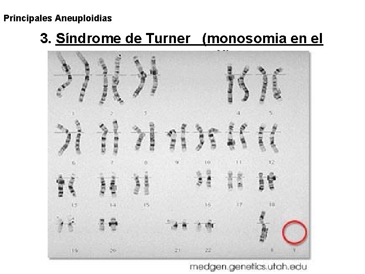 Principales Aneuploidias 3. Síndrome de Turner (monosomia en el cromosoma X) 