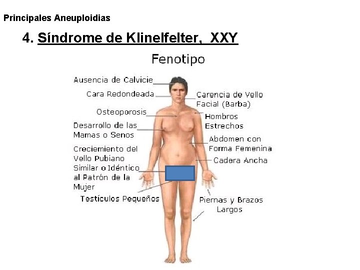 Principales Aneuploidias 4. Síndrome de Klinelfelter, XXY Principales Aneuploidias 4. Síndrome de Klinelfelter, XXY