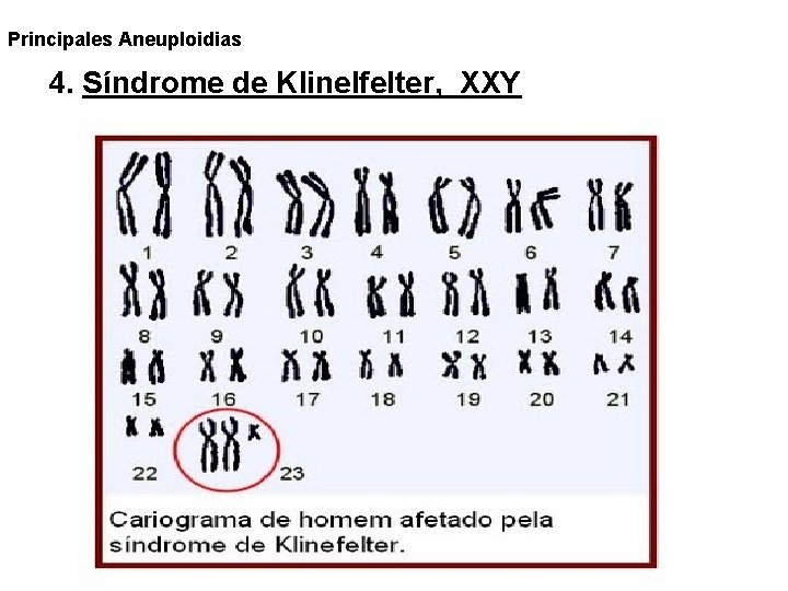 Principales Aneuploidias 4. Síndrome de Klinelfelter, XXY Principales Aneuploidias 4. Síndrome de Klinelfelter, XXY