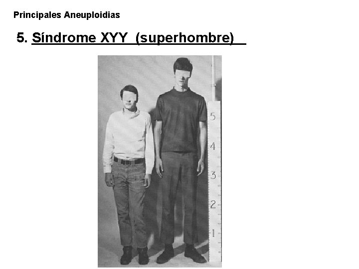 Principales Aneuploidias 5. Síndrome XYY (superhombre) 