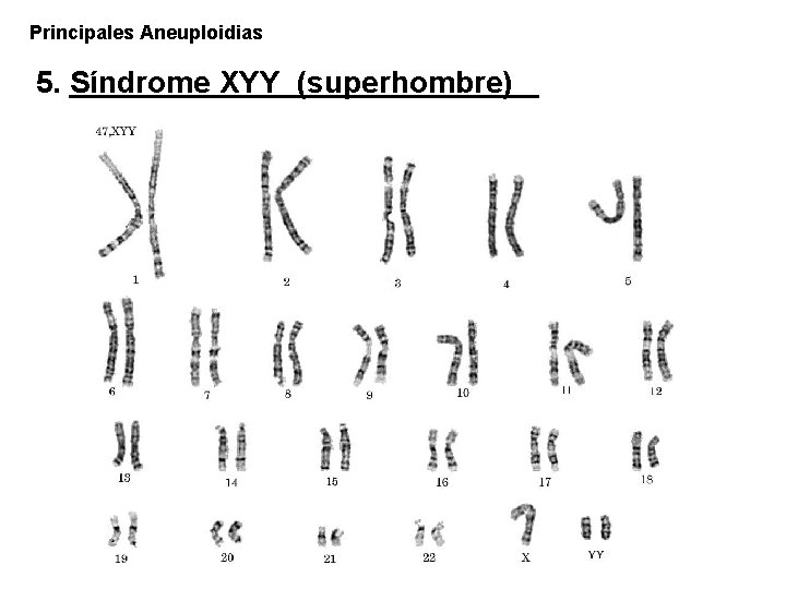 Principales Aneuploidias 5. Síndrome XYY (superhombre) 