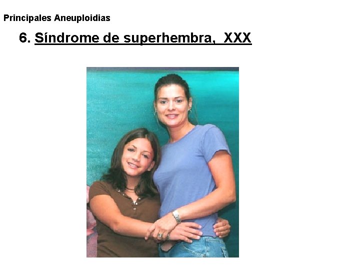 Principales Aneuploidias 6. Síndrome de superhembra, XXX Principales Aneuploidias 6. Síndrome de superhembra, XXX