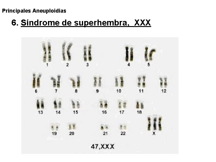 Principales Aneuploidias 6. Síndrome de superhembra, XXX 