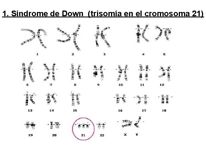 1. Síndrome de Down (trisomía en el cromosoma 21) 1. Síndrome de Down (trisomía en el cromosoma 21)