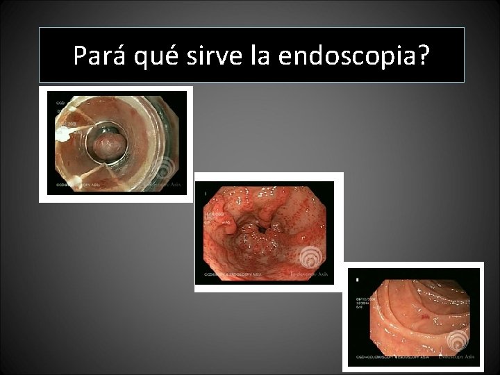 Pará qué sirve la endoscopia? Pará qué sirve la endoscopia?