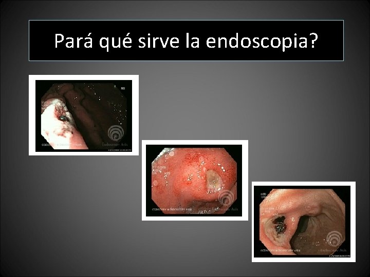 Pará qué sirve la endoscopia? Pará qué sirve la endoscopia?