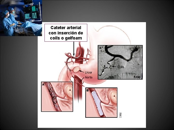 Cateter arterial con inserción de coils o gelfoam Cateter arterial con inserción de coils o gelfoam