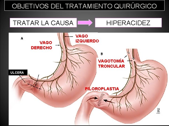 OBJETIVOS DEL TRATAMIENTO QUIRÚRGICO TRATAR LA CAUSA VAGO DERECHO HIPERACIDEZ VAGO IZQUIERDO VAGOTOMÍA TRONCULAR OBJETIVOS DEL TRATAMIENTO QUIRÚRGICO TRATAR LA CAUSA VAGO DERECHO HIPERACIDEZ VAGO IZQUIERDO VAGOTOMÍA TRONCULAR
