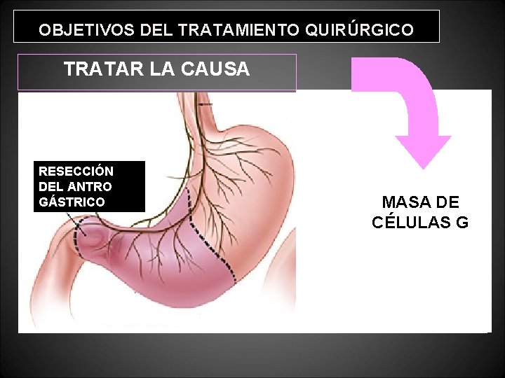 OBJETIVOS DEL TRATAMIENTO QUIRÚRGICO TRATAR LA CAUSA VAGOTOMÍA RESECCIÓN DEL ANTRO GÁSTRICO MASA DE OBJETIVOS DEL TRATAMIENTO QUIRÚRGICO TRATAR LA CAUSA VAGOTOMÍA RESECCIÓN DEL ANTRO GÁSTRICO MASA DE