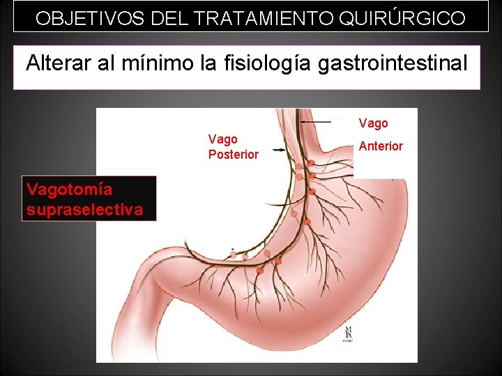 OBJETIVOS DEL TRATAMIENTO QUIRÚRGICO Alterar al mínimo la fisiología gastrointestinal Vago Posterior Vagotomía supraselectiva OBJETIVOS DEL TRATAMIENTO QUIRÚRGICO Alterar al mínimo la fisiología gastrointestinal Vago Posterior Vagotomía supraselectiva