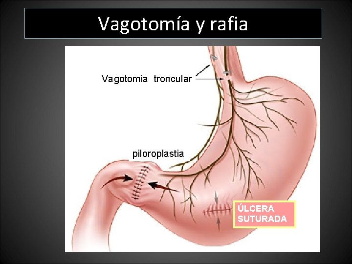 Vagotomía y rafia Vagotomia troncular piloroplastia ÚLCERA SUTURADA Vagotomía y rafia Vagotomia troncular piloroplastia ÚLCERA SUTURADA