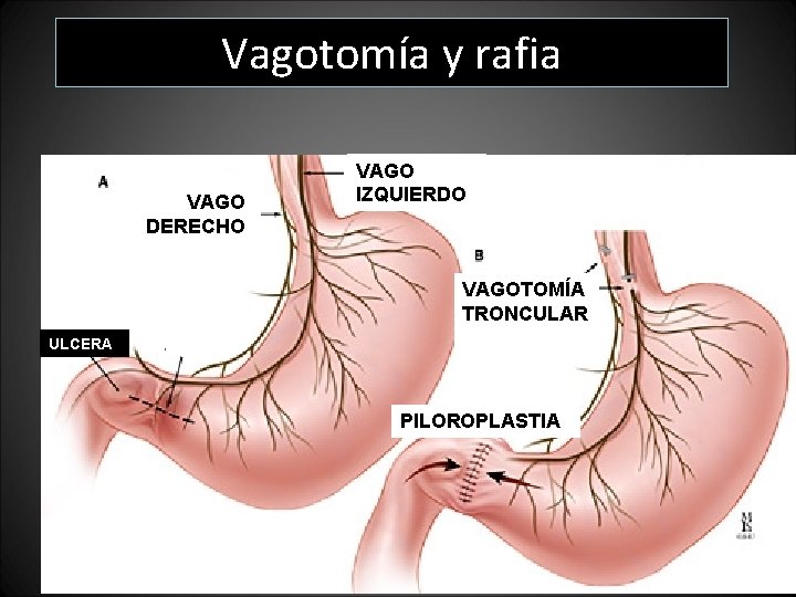 Vagotomía y rafia VAGO DERECHO VAGO IZQUIERDO VAGOTOMÍA TRONCULAR ULCERA PILOROPLASTIA Vagotomía y rafia VAGO DERECHO VAGO IZQUIERDO VAGOTOMÍA TRONCULAR ULCERA PILOROPLASTIA