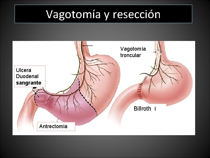 Vagotomía y resección Vagotomía troncular Ulcera Duodenal sangrante Billroth I Antrectomia Vagotomía y resección Vagotomía troncular Ulcera Duodenal sangrante Billroth I Antrectomia