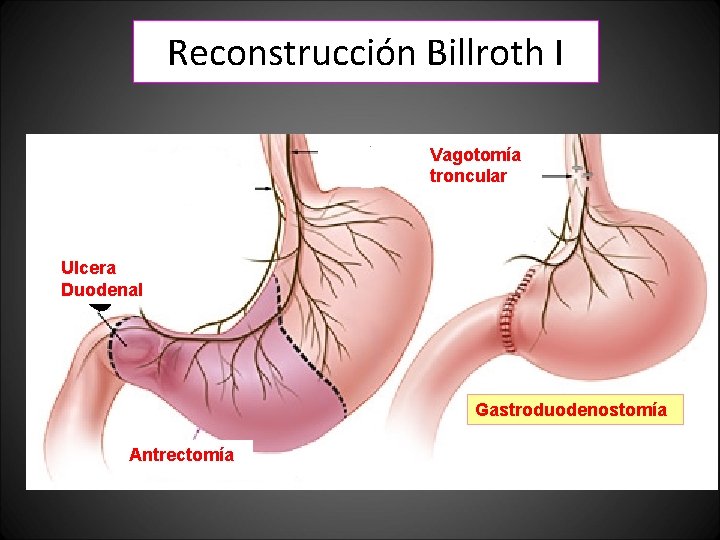 Reconstrucción Billroth I Vagotomía troncular Ulcera Duodenal Gastroduodenostomía Antrectomía Reconstrucción Billroth I Vagotomía troncular Ulcera Duodenal Gastroduodenostomía Antrectomía