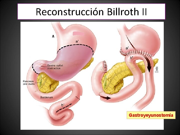 Reconstrucción Billroth II Yeyuno Gastroyeyunostomía Reconstrucción Billroth II Yeyuno Gastroyeyunostomía