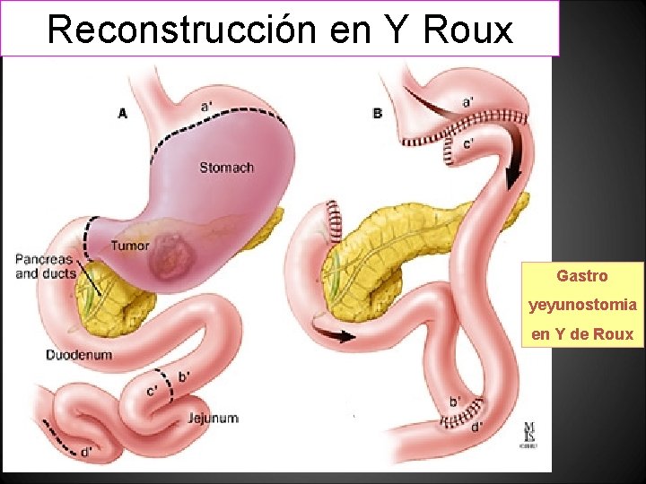 Reconstrucción en Y Roux Gastro yeyunostomia en Y de Roux Reconstrucción en Y Roux Gastro yeyunostomia en Y de Roux