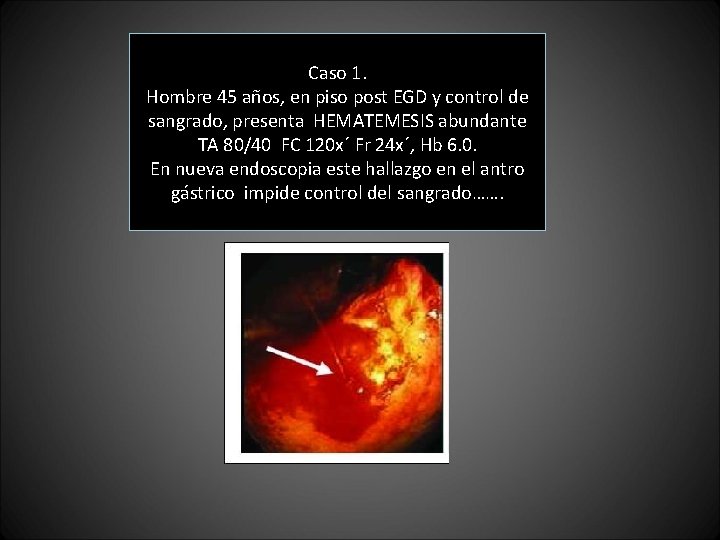Caso 1. Hombre 45 años, en piso post EGD y control de sangrado, presenta Caso 1. Hombre 45 años, en piso post EGD y control de sangrado, presenta