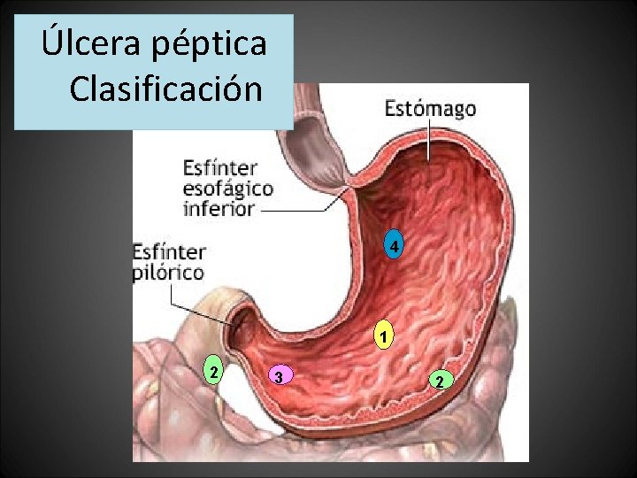 Úlcera péptica Clasificación 4 1 2 3 2 Úlcera péptica Clasificación 4 1 2 3 2
