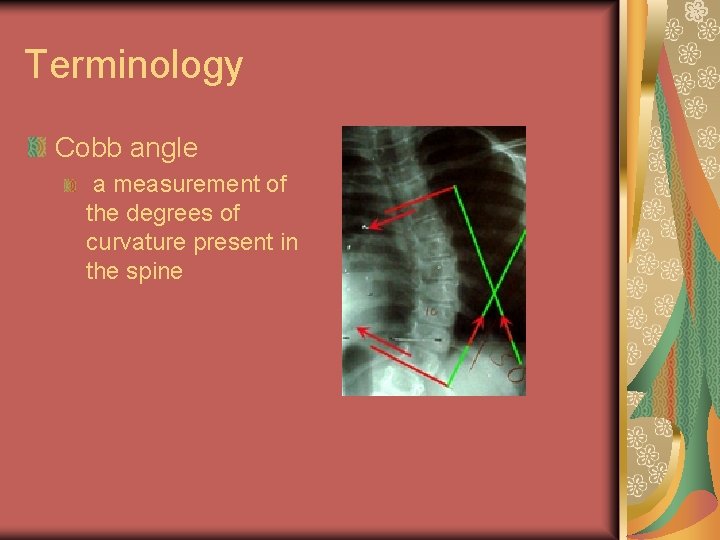 Terminology Cobb angle a measurement of the degrees of curvature present in the spine Terminology Cobb angle a measurement of the degrees of curvature present in the spine