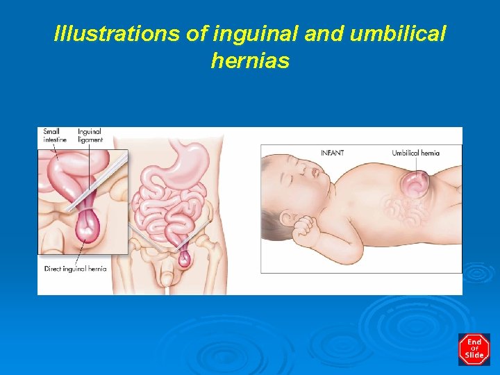 Illustrations of inguinal and umbilical hernias 